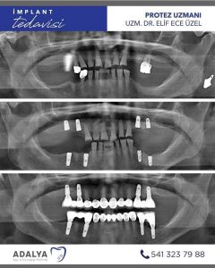 döşemealtı diş polikliniği antalya implant tedavisi