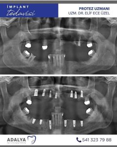 dosemealti dis implant poliklinigi antalya