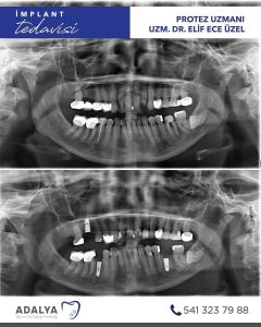 dosemealti implant tedavisi klinigi antalya